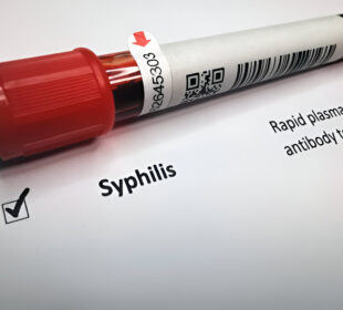 Sifilis