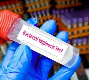 Bakterinė vaginozė