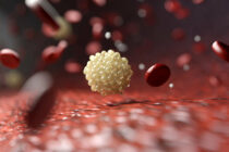 Blogasis cholesterolis