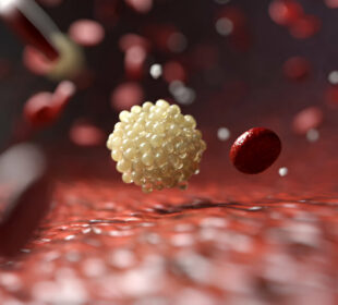 Blogasis cholesterolis