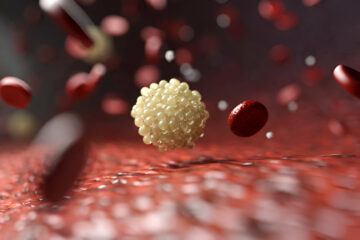 Blogasis cholesterolis