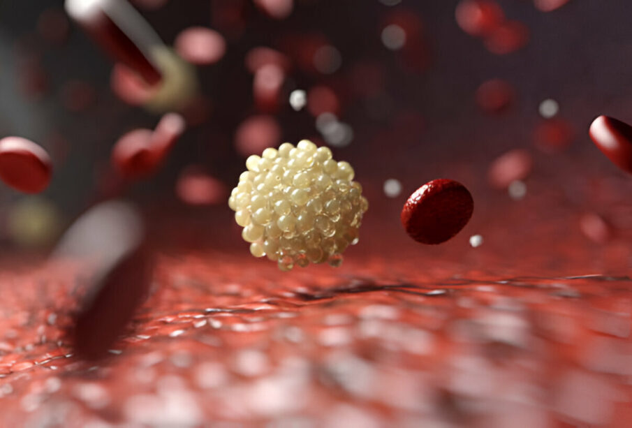 Blogasis cholesterolis