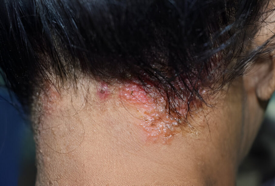 Seborėjinis dermatitas