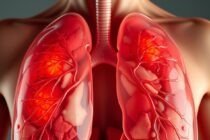 plaučių uždegimas