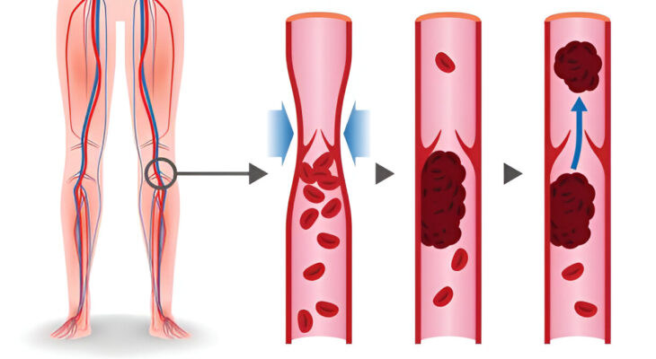 Gerybinis fascikuliacijų sindromas