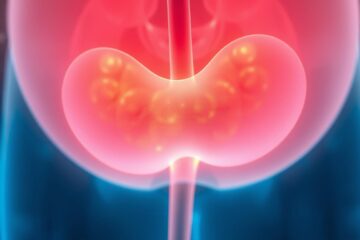 Šlapimo pūslės uždegimas