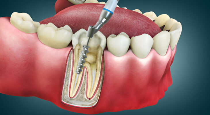 Dantų šaknų kanalų gydymas
