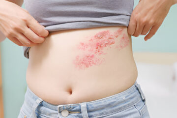 Juostinė pūslelinė