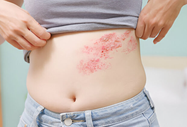 Juostinė pūslelinė