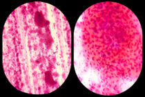 Mycoplasma genitalium