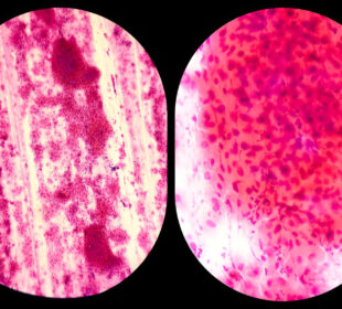 Mycoplasma genitalium