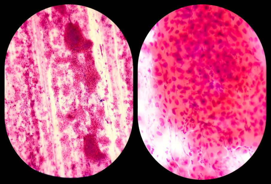 Mycoplasma genitalium
