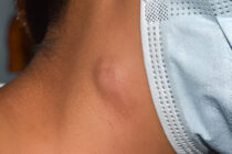 Padidėję limfmazgiai