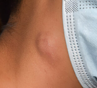 Padidėję limfmazgiai