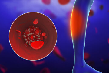 Periferinė arterijų liga