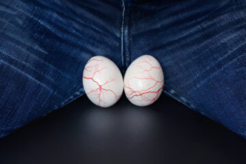 Testikulinė atrofija: