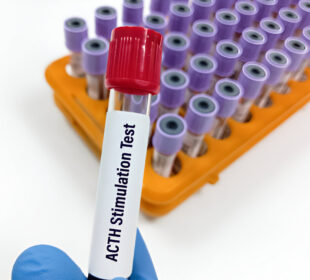 ACTH stimuliacijos testas