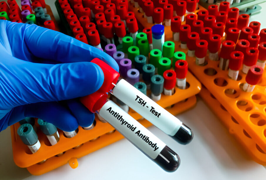 Antitirolobulino tyrimas skydliaukės būklei įvertinti