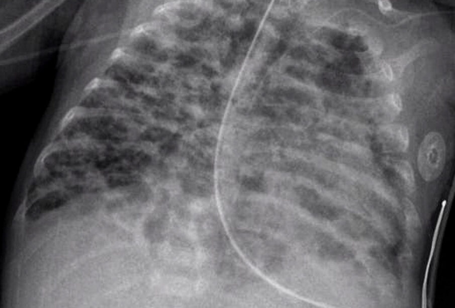 Bronchopulmoninė displazija