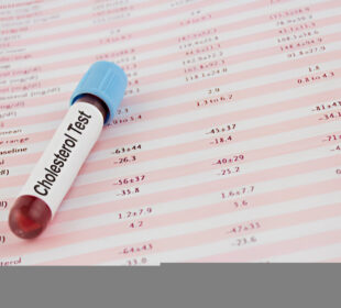 Cholesterolio tyrimas