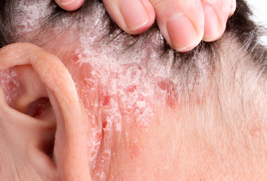 Eritroderminė psoriazė