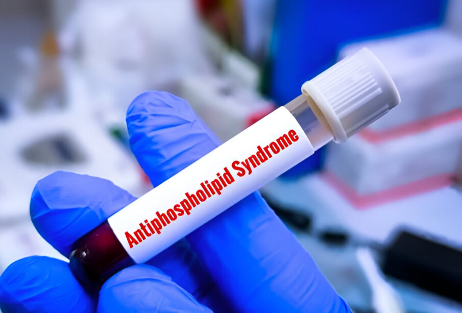 Kardiolipino antikūnų testas