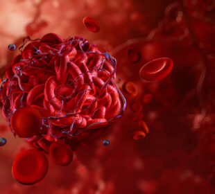 Kraujagyslių krešuliai