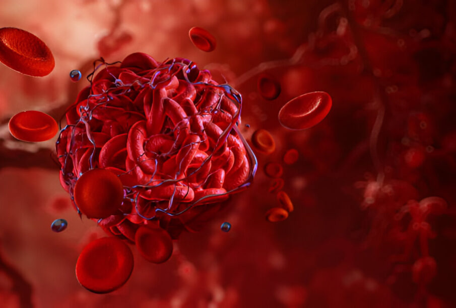 Kraujagyslių krešuliai