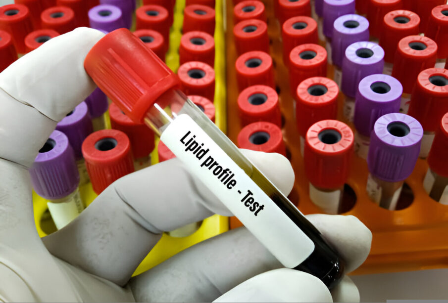 Lipidų profilis
