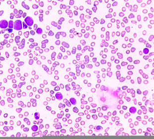 Padidėjęs eozinofilų kiekis kraujyje