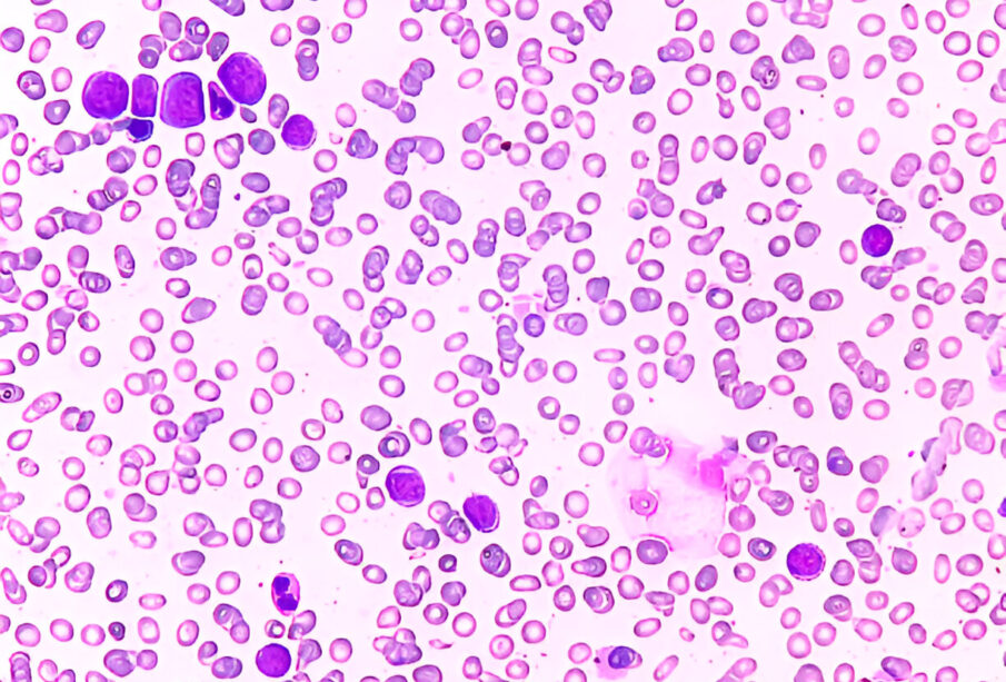 Padidėjęs eozinofilų kiekis kraujyje