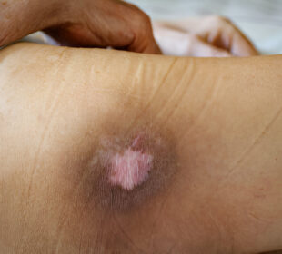 Slėgio opų prevencija ir gydymas