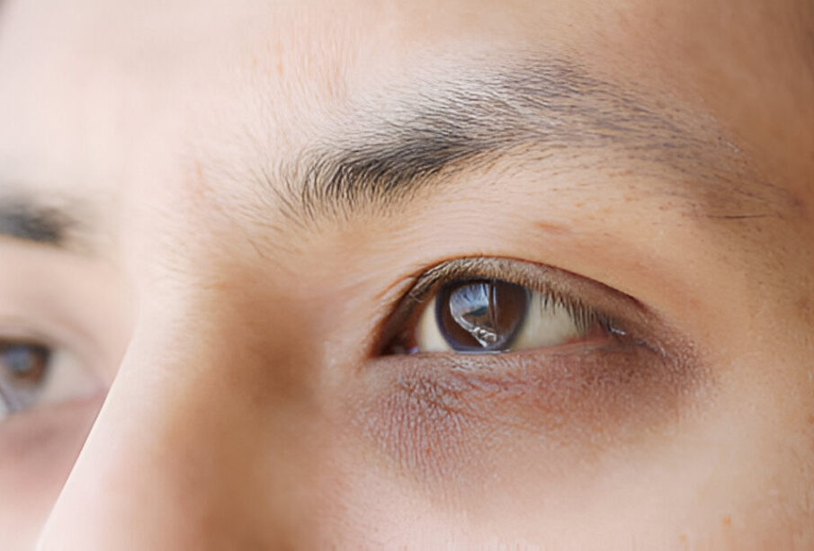 Tamsūs ratilai po akimis