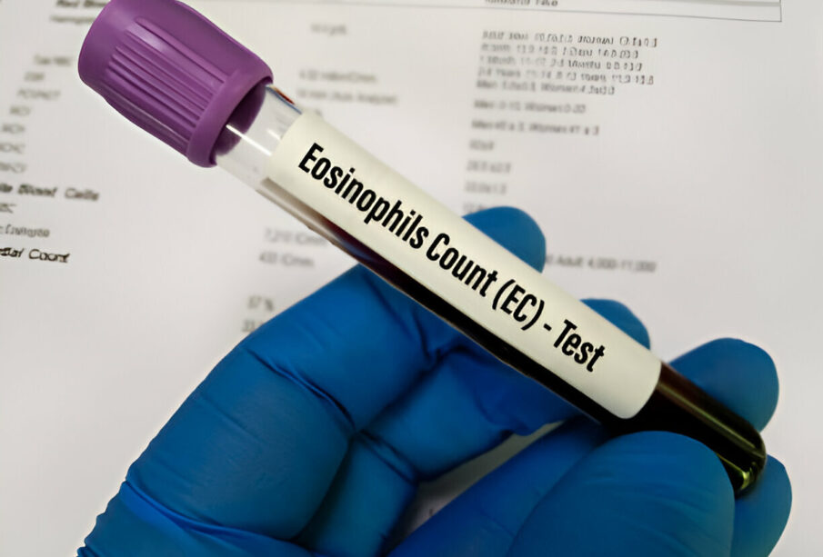 Tikslaus absoliutaus eozinofilų skaičiaus tyrimas ir rezultatai